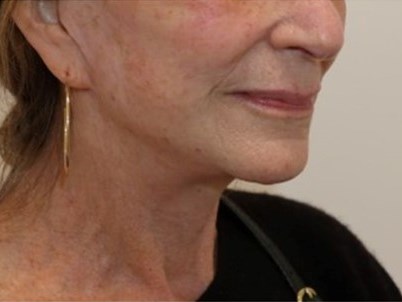Facelift Surgery After
