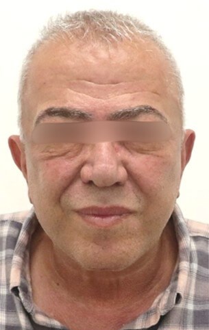 Facelift and Neck Surgery After