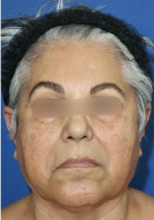 Facelift Surgery Before