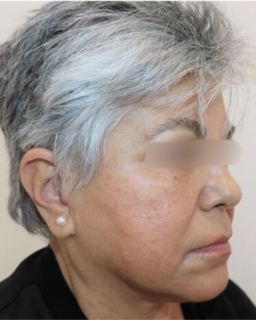 Facelift Surgery After