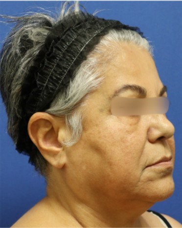 Facelift Surgery Before