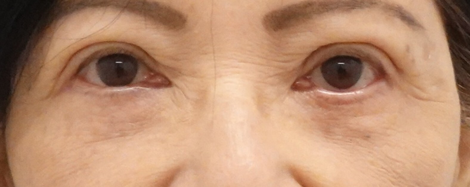Lower Eyelid Surgery After