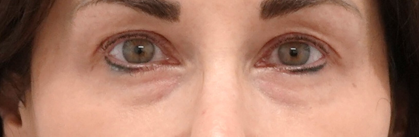 Upper Eyelid Surgery Before