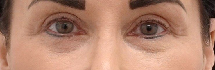 Upper Eyelid Surgery After