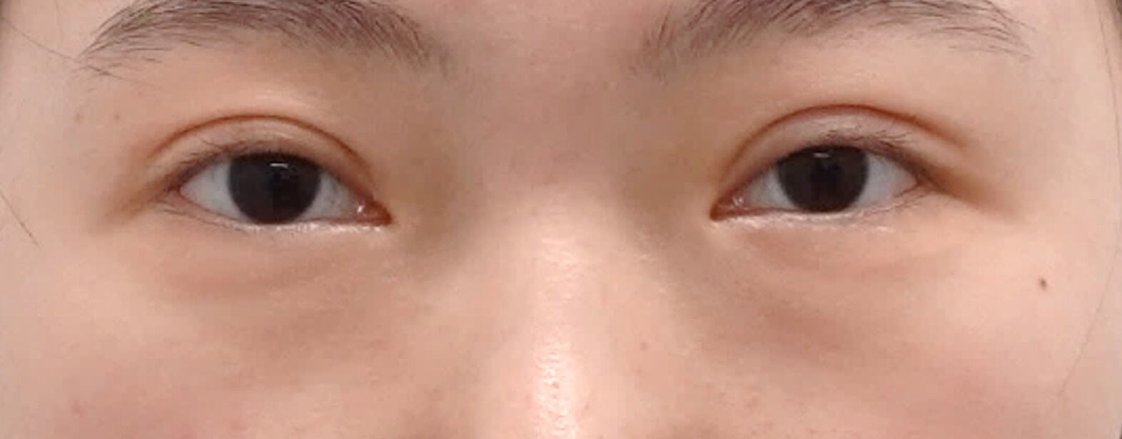 Asian Eyelid Surgery After
