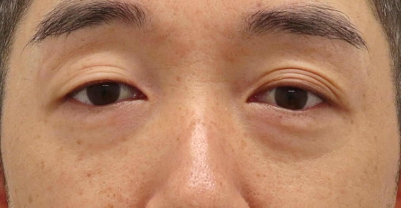 Lower Eyelid Surgery Before