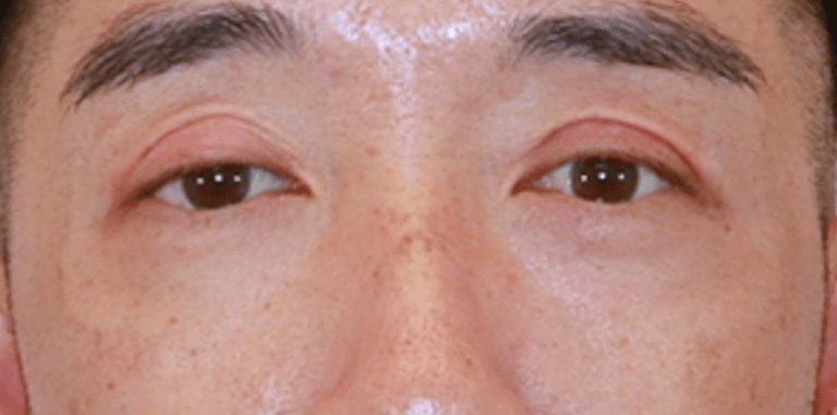 Lower Eyelid Surgery After