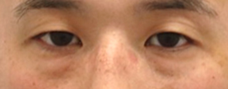 Lower Eyelid Surgery Before