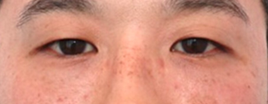 Lower Eyelid Surgery After