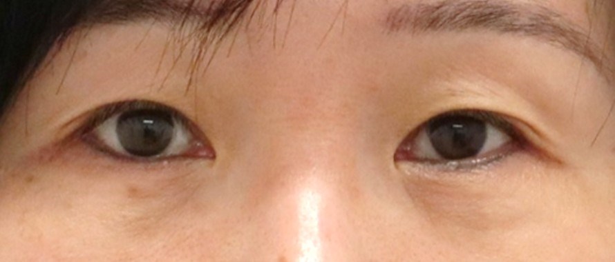 Lower Eyelid Surgery After