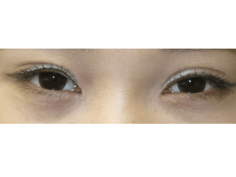 Before and After Asian Eyelid Surgery Photos