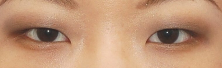 Incisional Open Technique Before