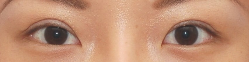 Incisional Open Technique After