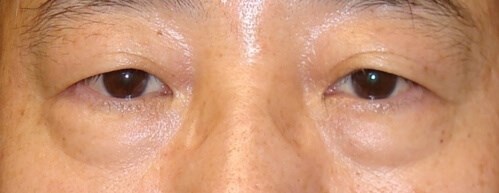 Lower Eyelid Surgery Before