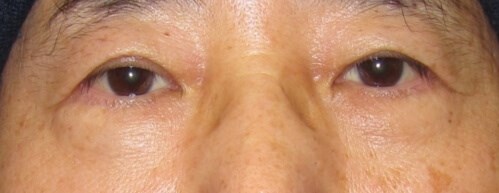 Lower Eyelid Surgery After