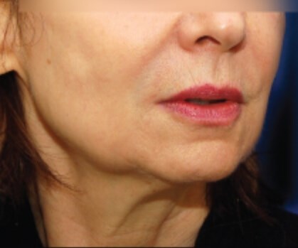 Lower Face Lift with Neck Lift Before