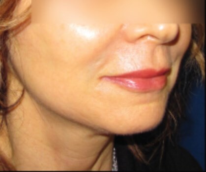 Lower Face Lift with Neck Lift After