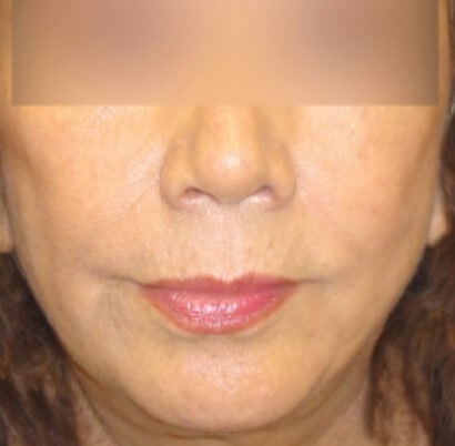Face Lift After