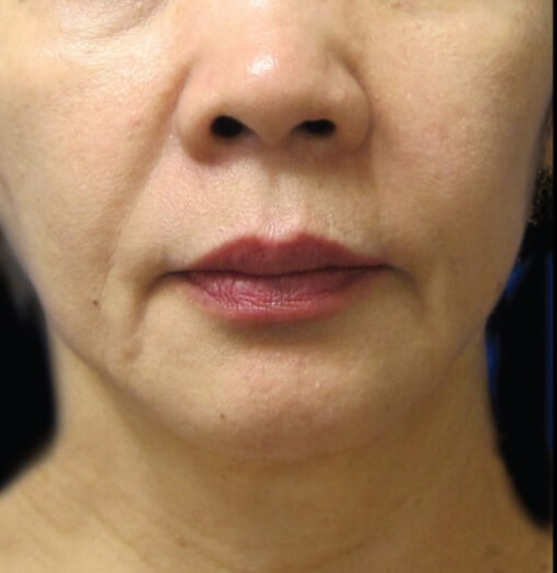 Mini Facelift Before