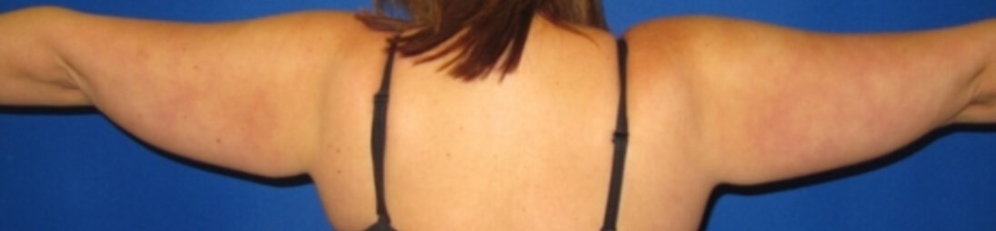 Arm Lipoplasty Before