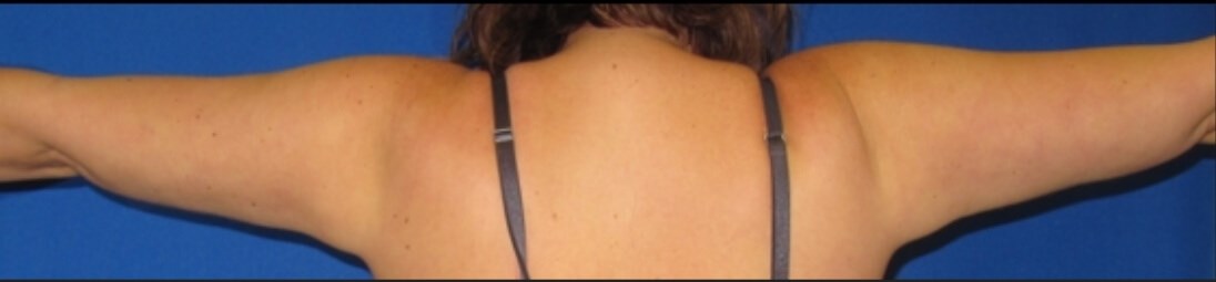 Arm Lipoplasty After