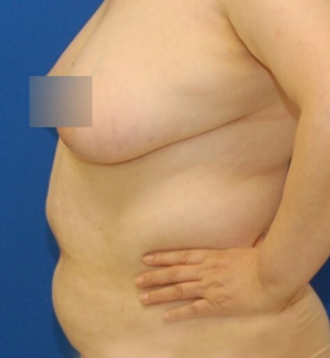 Abdominal Liposuction Before