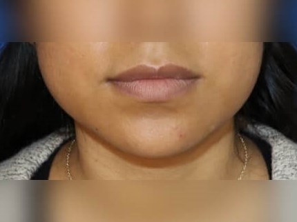 Buccal Fat Removal Before