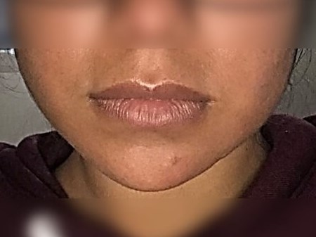 Buccal Fat Removal After