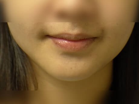 Botox After