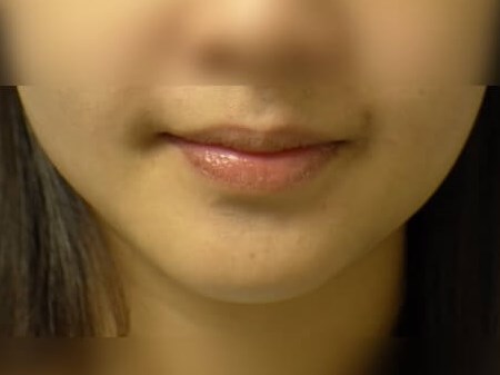 Buccal Fat Removal After