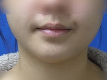 Buccal Fat Removal Before