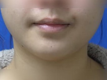 Botox Before