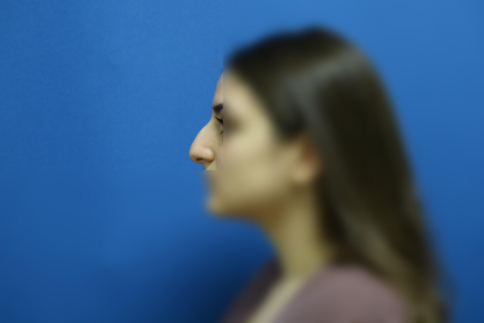 Rhinoplasty Before