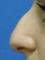 Rhinoplasty Before