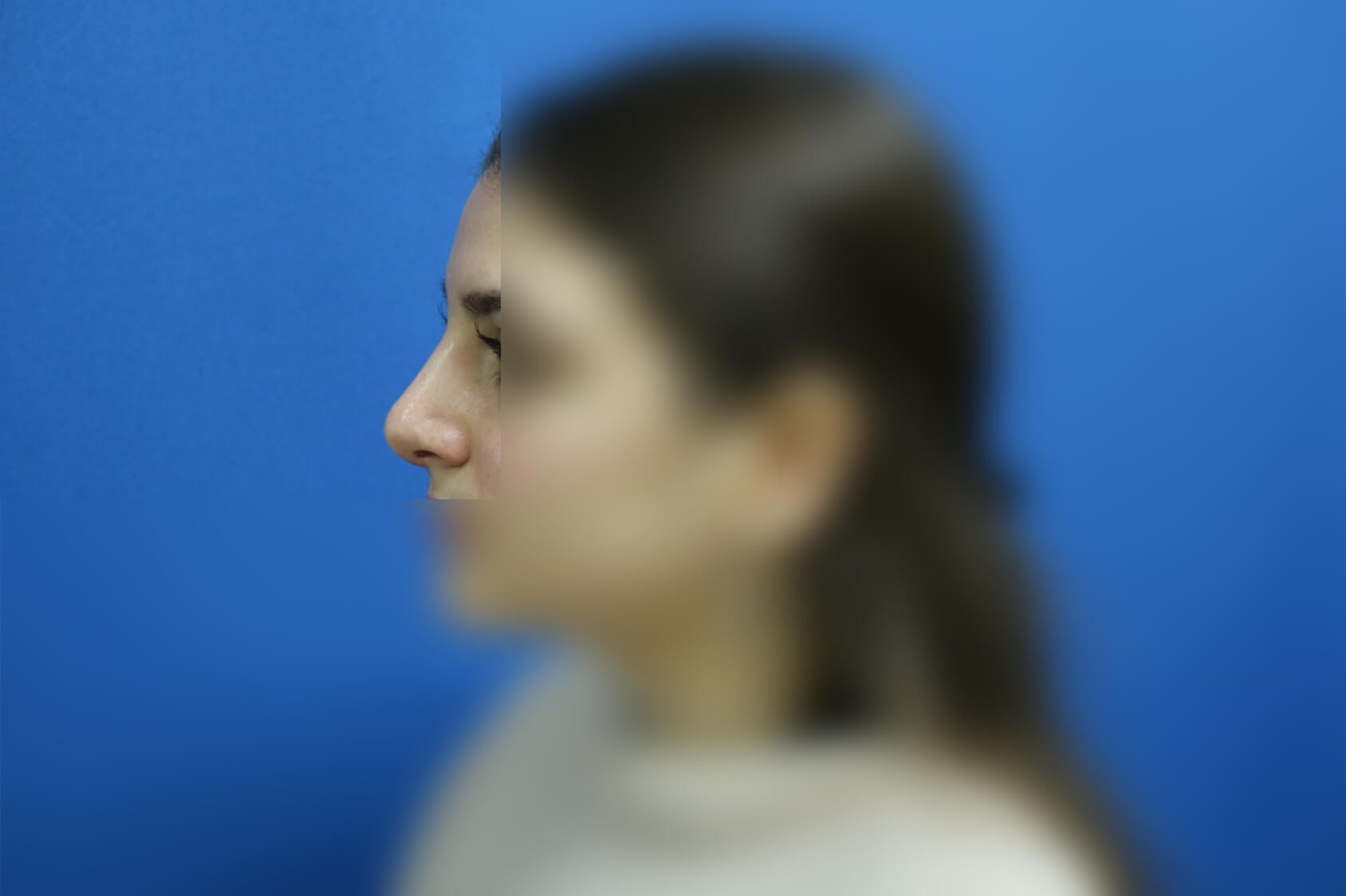 Rhinoplasty After