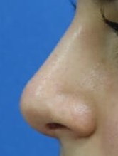 Rhinoplasty After