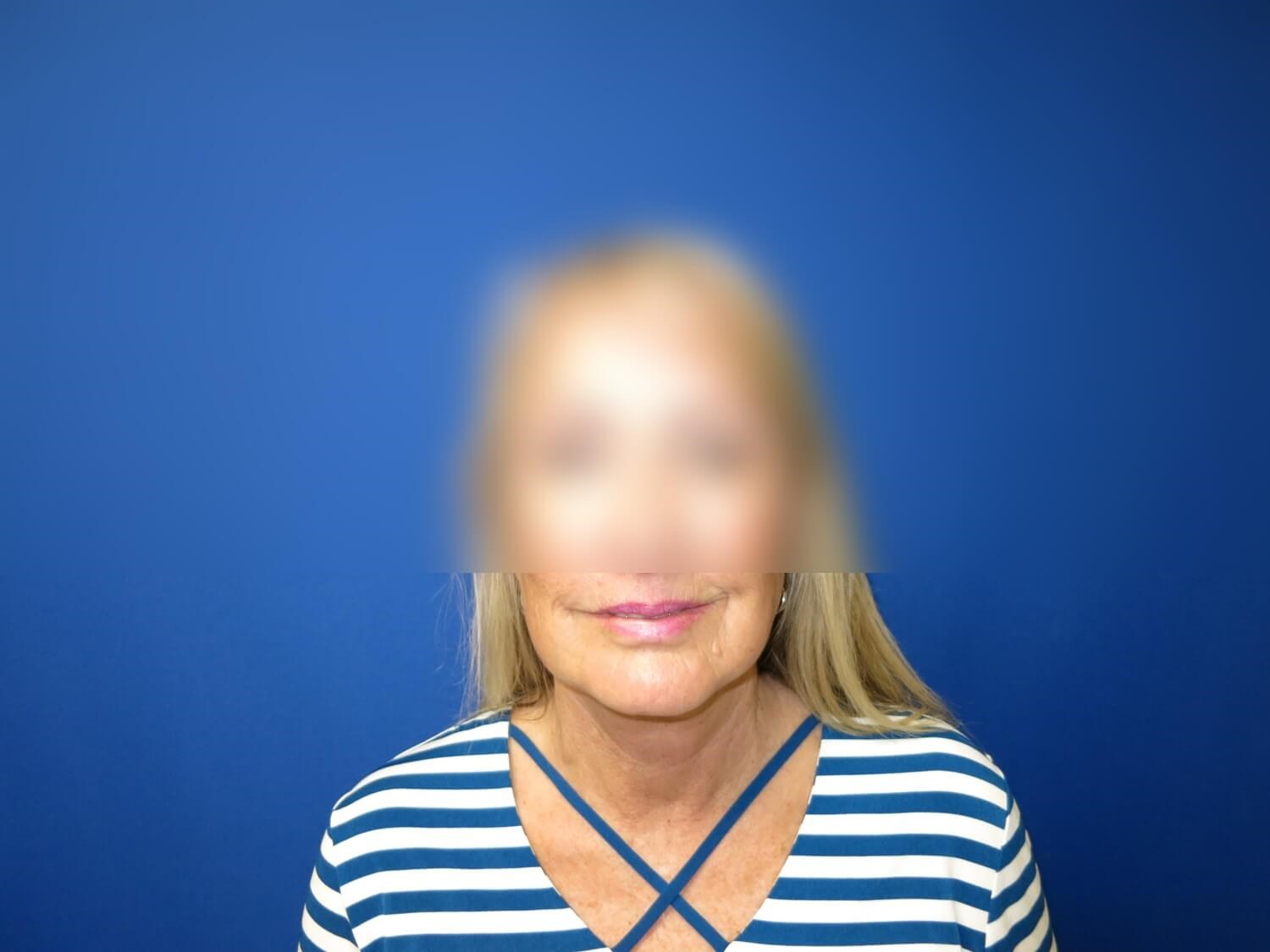 Face Lift and Neck Lift After