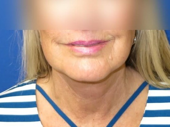 Face Lift and Neck Lift After