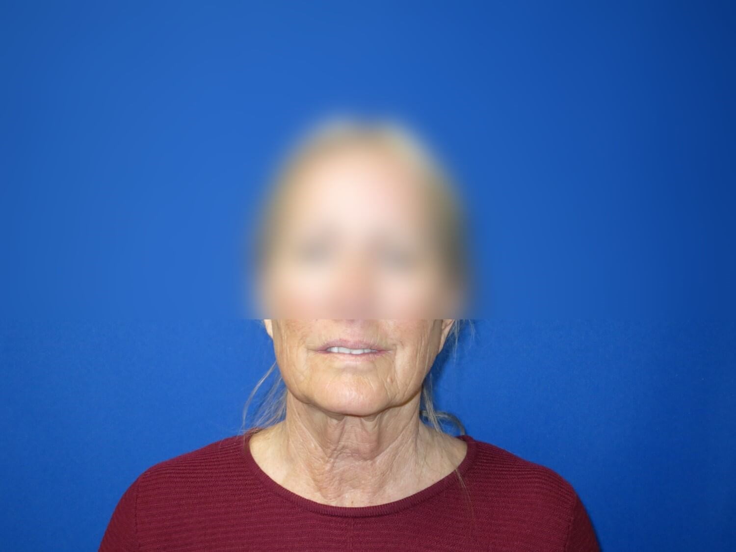 Face Lift and Neck Lift Before