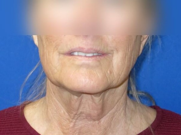 Face Lift and Neck Lift Before