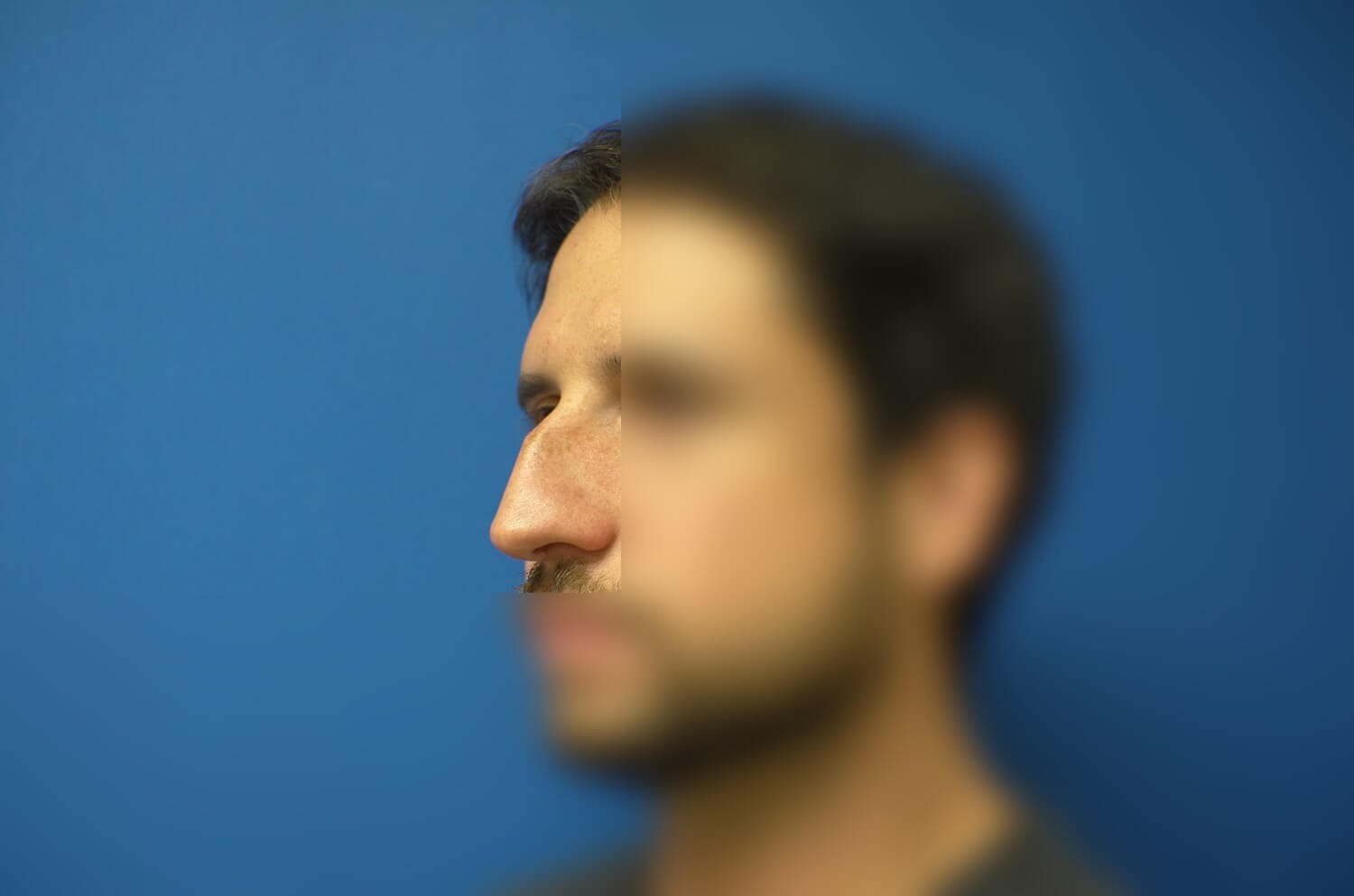 Rhinoplasty Before