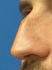 Rhinoplasty Before