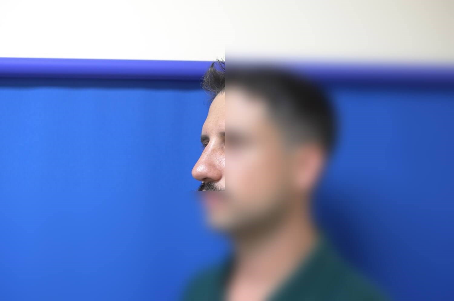 Rhinoplasty After
