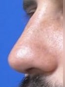 Rhinoplasty After