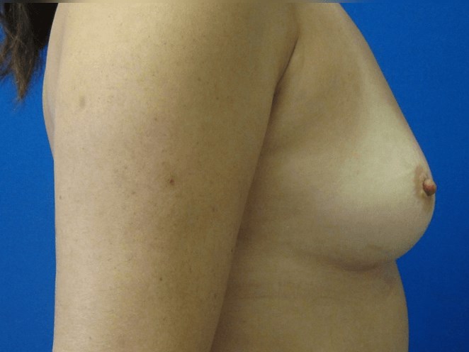 Breast Augmentation Before