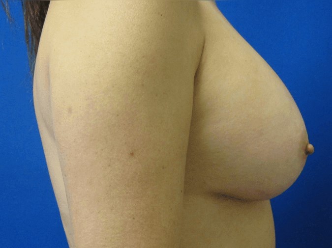 Breast Augmentation After