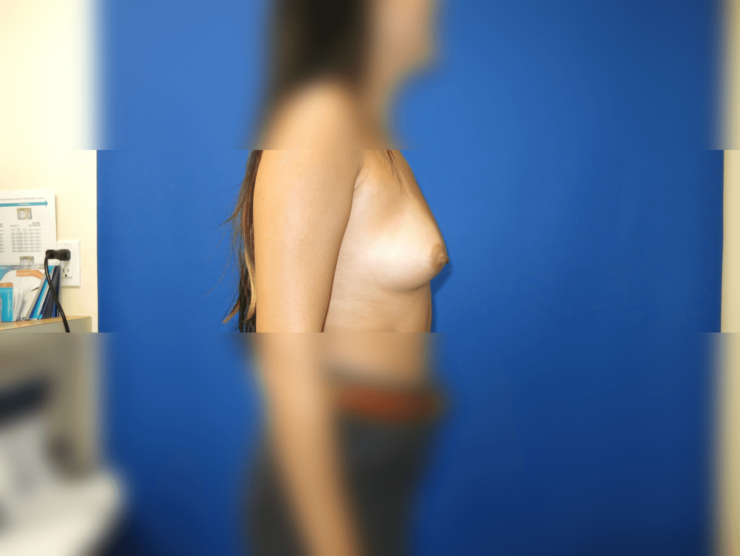 Breast Augmentation Before