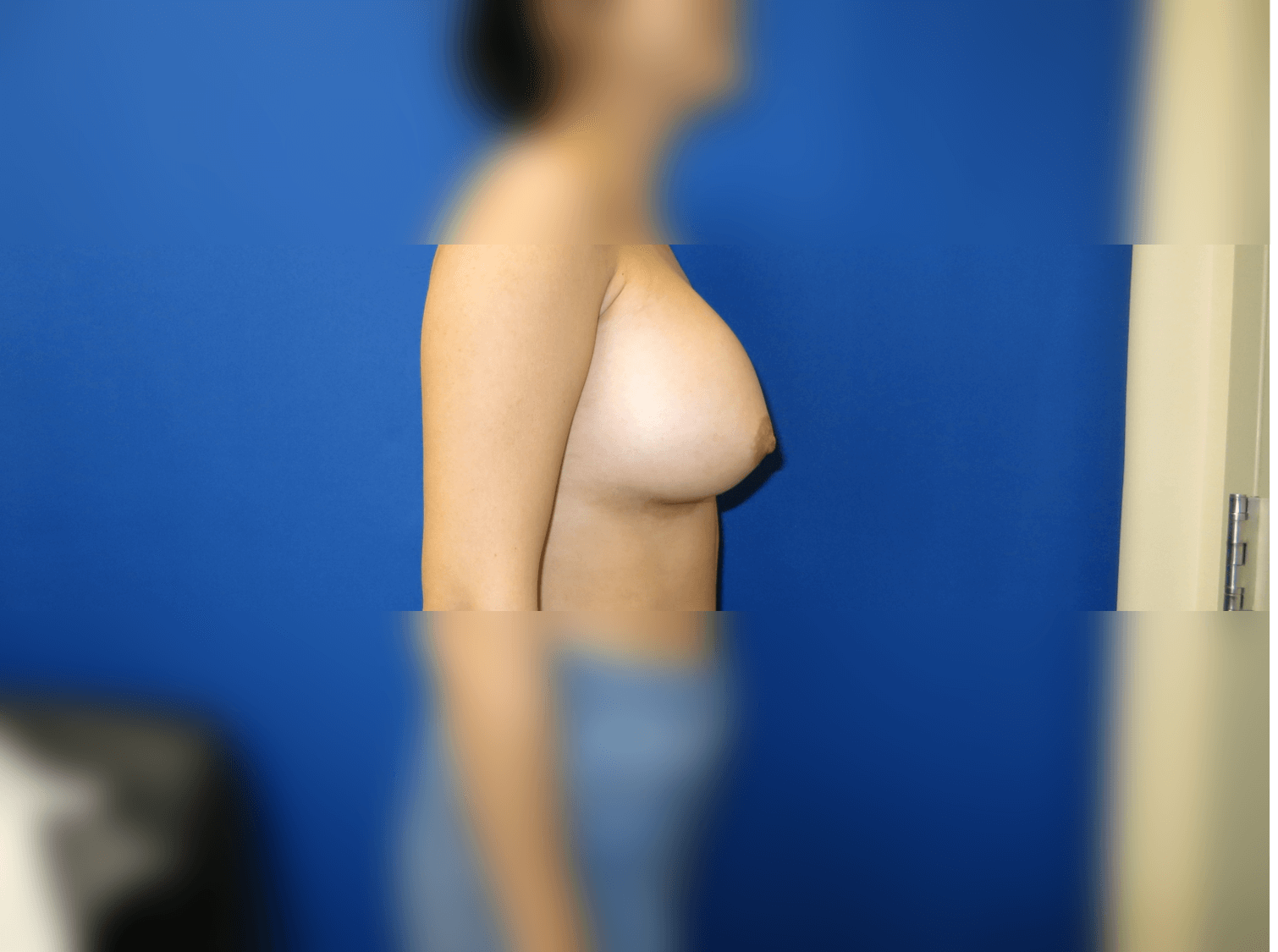 Breast Augmentation After