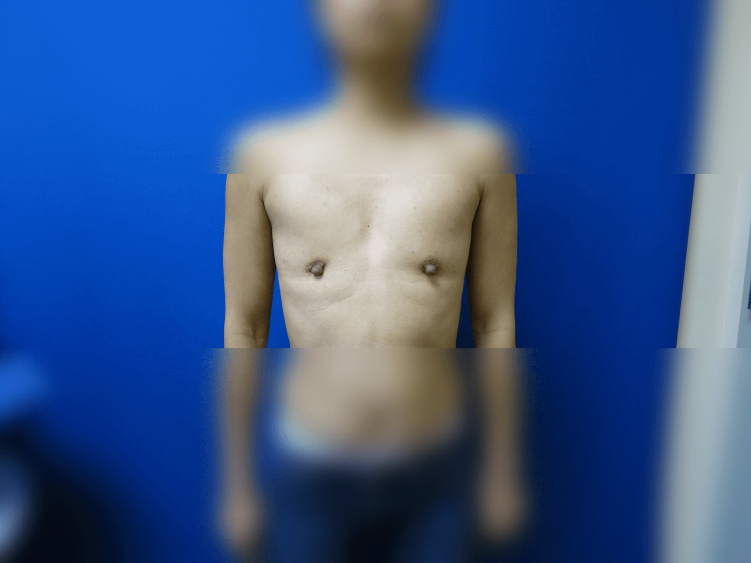 Breast Augmentation Before