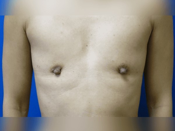 Breast Augmentation Before